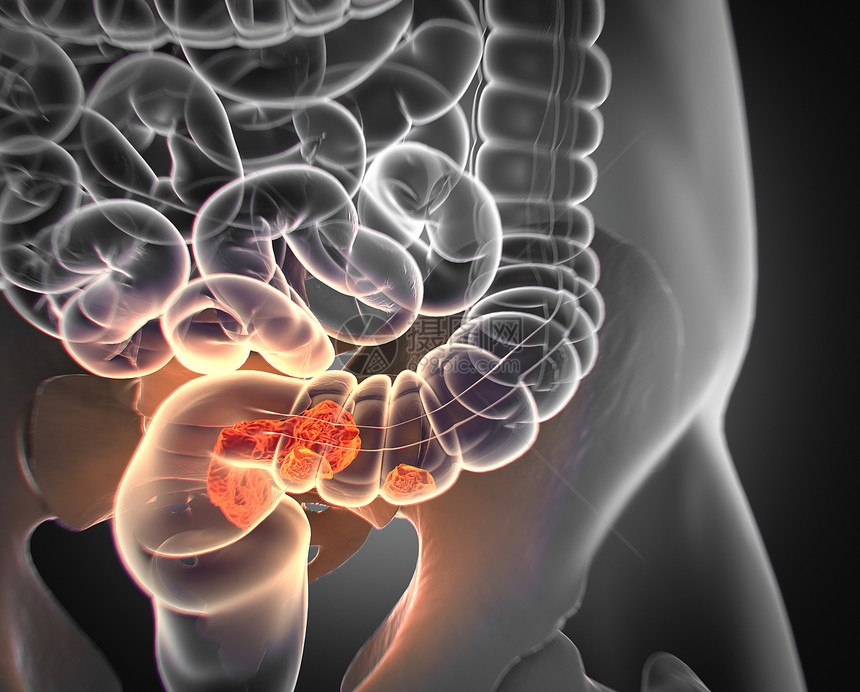 结直肠癌解剖model3d插图图片