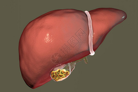 胆道石块3D插图展示肝脏前视和装设计图片