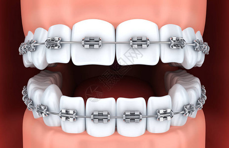 上颌骨人类颌牙和支架3d插图设计图片