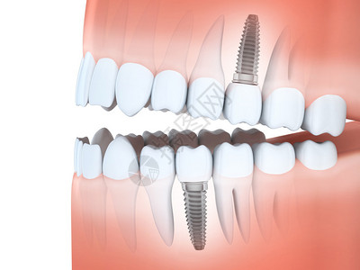 上颌骨人下巴牙齿和牙科植入物设计图片