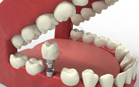 牙齿人类植入物种植牙的概念人类牙齿或假牙和科工具3D渲染图片