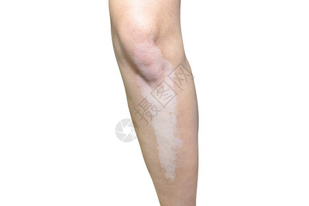掌静脉识别一位年轻的高加索女腿部从维蒂里戈病中扎根背景