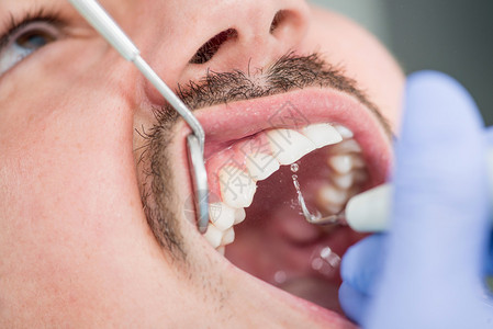 牙菌斑去除剂男患者在牙医办公室去除牙菌斑背景