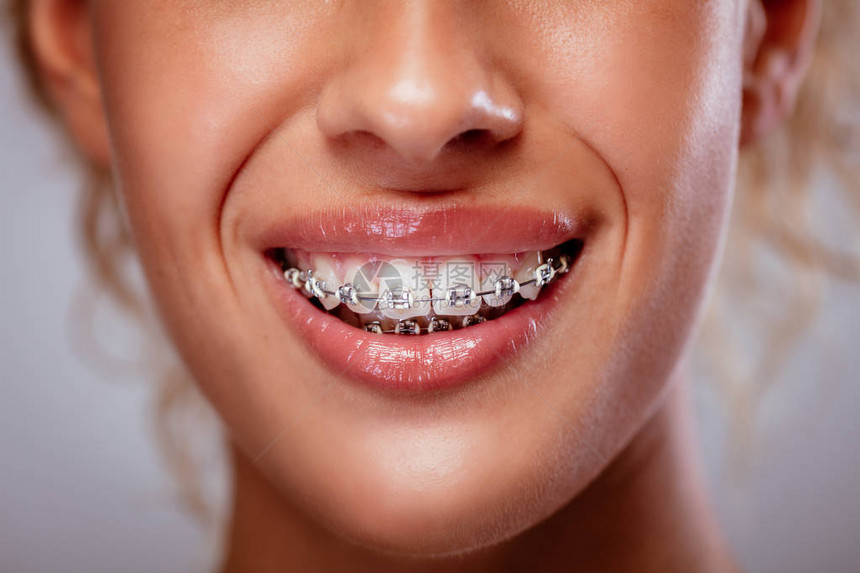 一个带牙套和微笑的女人洁白牙齿的特写镜头图片