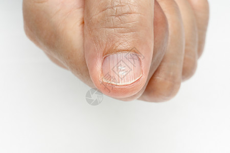 指甲上的白点和竖脊症状缺乏维生素和矿物质图片
