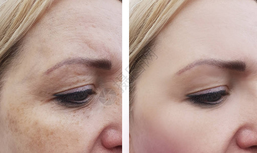 女人在手术前后皱纹色素沉着脸图片