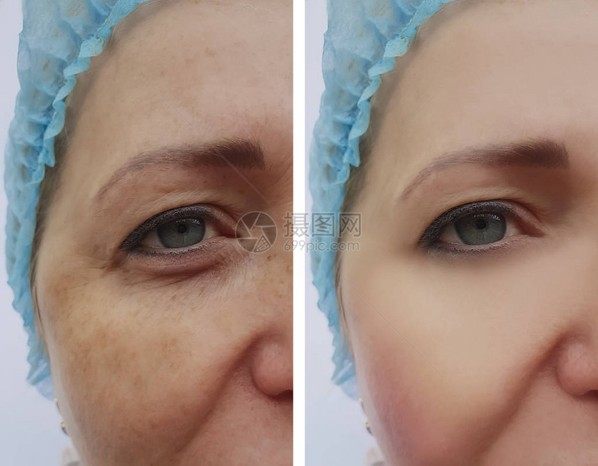 女人在手术前后皱纹色素沉着脸图片