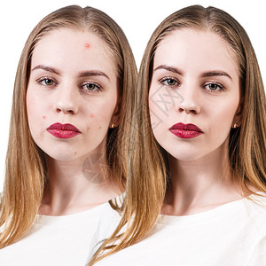 女在治疗前后和治疗前后的脸部皮肤有问题图片