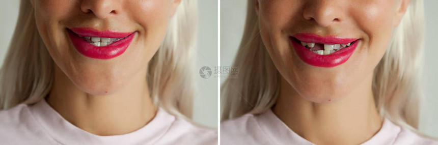断牙和种植牙前后图片
