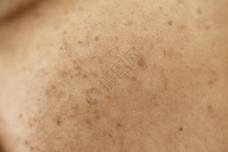 女人的问题皮肤痤疮疤痕油皮肤和毛孔黑斑和脸上背景图片