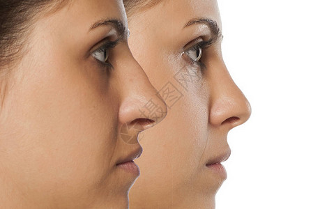 一名年轻妇女鼻子矫正前后和前后的比图片