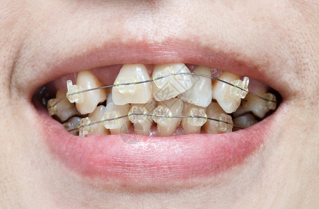 带牙套的弯曲牙齿的特写嘴图片