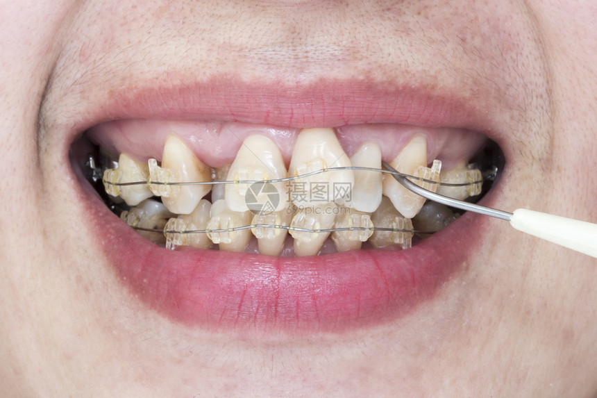 带牙套和牙菌斑去除剂的歪牙特写嘴图片
