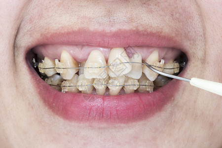 带牙套和牙菌斑去除剂的歪牙特写嘴图片