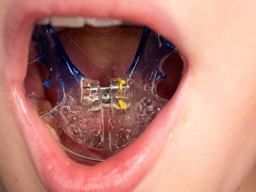 儿童嘴里的蓝色牙套图片