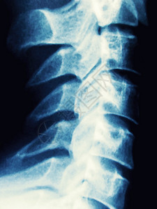 人体脊柱X光片的细节图片
