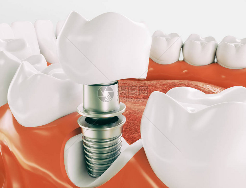 以下巴模型为例的牙科植入图片
