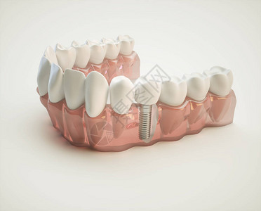 以颌模型为例的牙科植入物图片