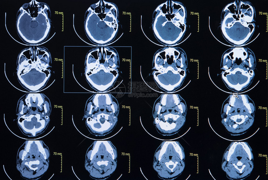 脑计算机断层成像图系列由脑部电图片
