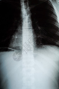 XRay人类胸前照片供医图片