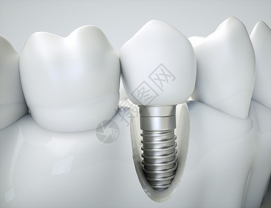 颌骨以颌模型为例的牙科植入物设计图片