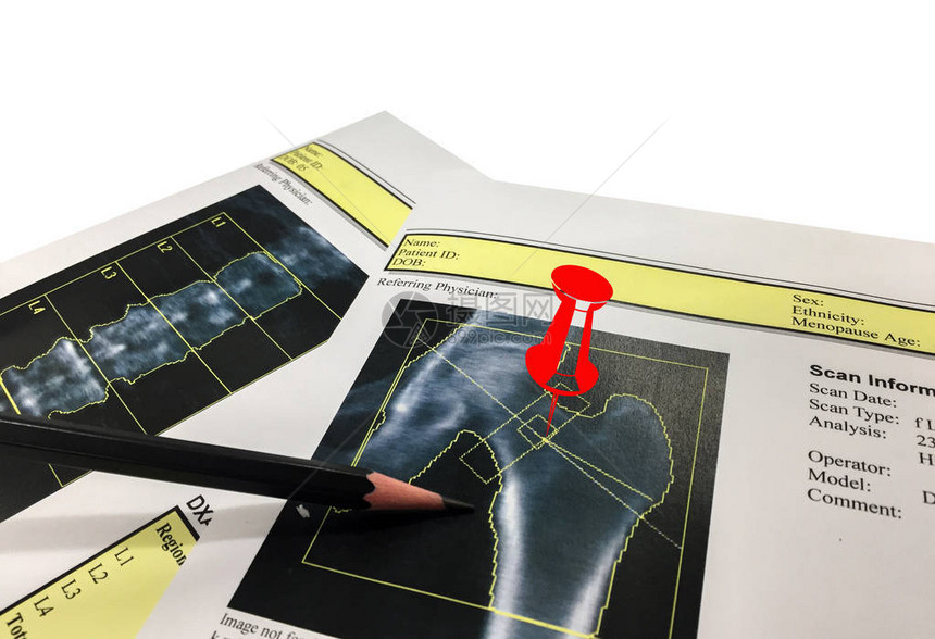 Hip和SpineBone矿藏密度BMDDEXA时空测距扫描Osteopenia存在图片