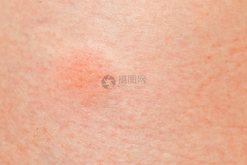 女人皮肤上的大蚊子疙瘩图片