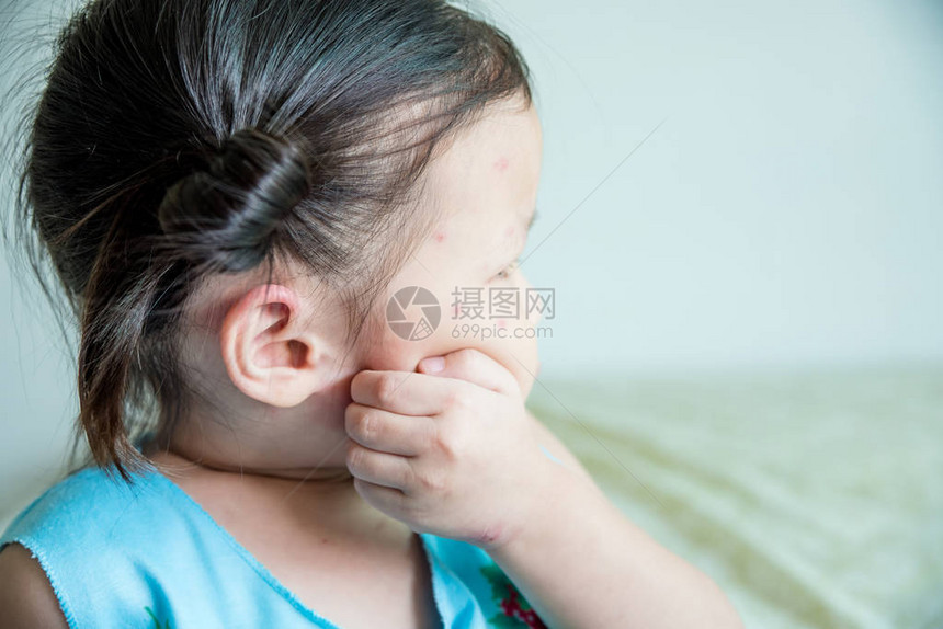 年轻的亚洲女孩因为被昆虫咬在脸图片