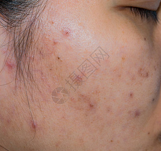 亚洲女油面部皮肤上的痤疮和痤疮斑点痤疮治疗前的概念和面部激光治疗以消除痤疮后的黑斑面部皮肤上的闭合粉刺背景图片