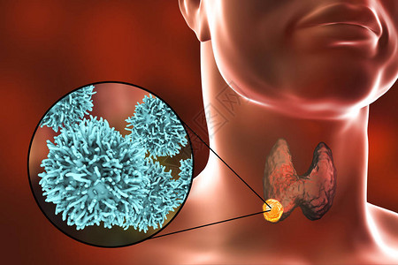 西昂甲状腺癌3D图解显示甲状腺人体内肿瘤和甲状腺设计图片
