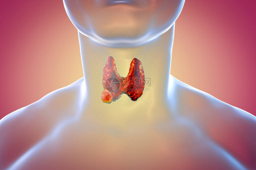 甲状腺癌3D图解显示人体内图片