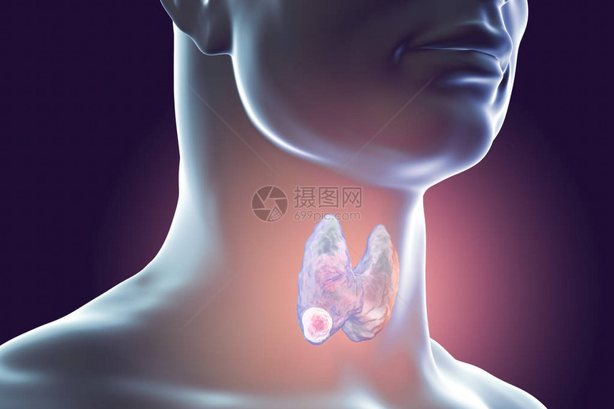 甲状腺癌3D图解显示人体内图片