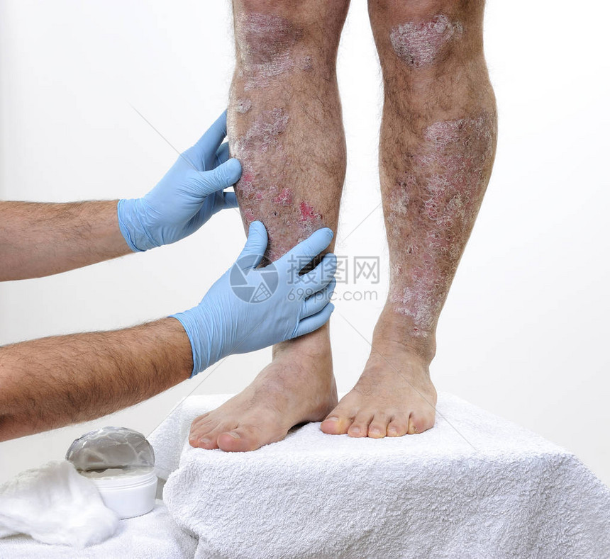 皮肤科医生用手套保护他的手研究一名成年男子腿部的炎症图片