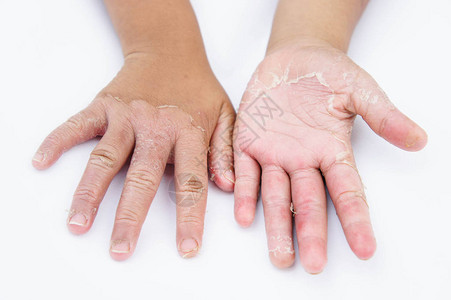 干手皮革接触皮炎真菌感染图片