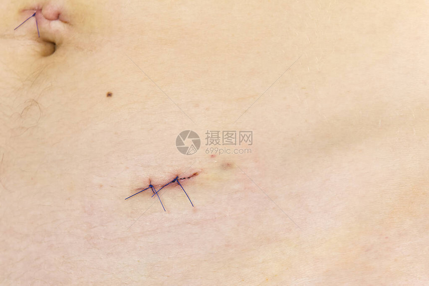 阑尾炎切除后的年轻身体疤痕腹腔镜手术后的小图片