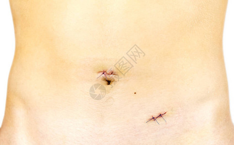 阑尾炎切除后的年轻身体疤痕腹腔镜手术后的小图片