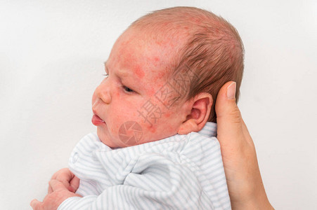 新生婴儿皮肤疹出生后过敏反应身体图片