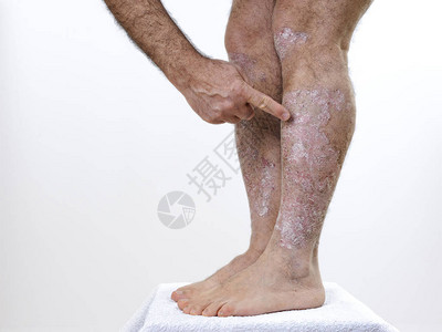 患有慢皮丝虫病的人用手指显示腿部发炎的部分是白种背景图片