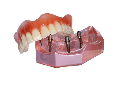 假牙在顶牙齿下巴的模型上与白底植入图片