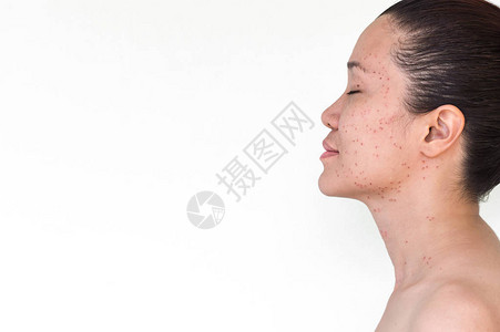 亚洲妇女脸部和颈部的烧焦点或激光处理皮雀斑图片
