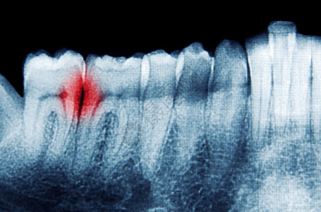 牙齿X射线扫描特写图片