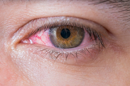 结膜炎红眼宏观图片