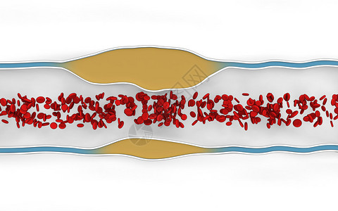 动脉壁斑块的形成高清图片