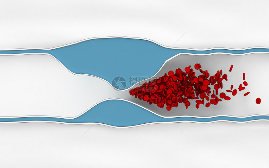 缺血硬化病阻止血图片