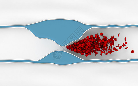 缺血硬化病阻止血高清图片