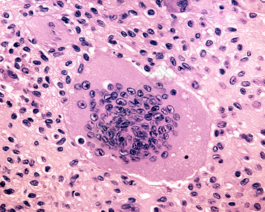 来自破骨细胞的多核巨细胞人体骨巨细胞瘤的活检高清图片