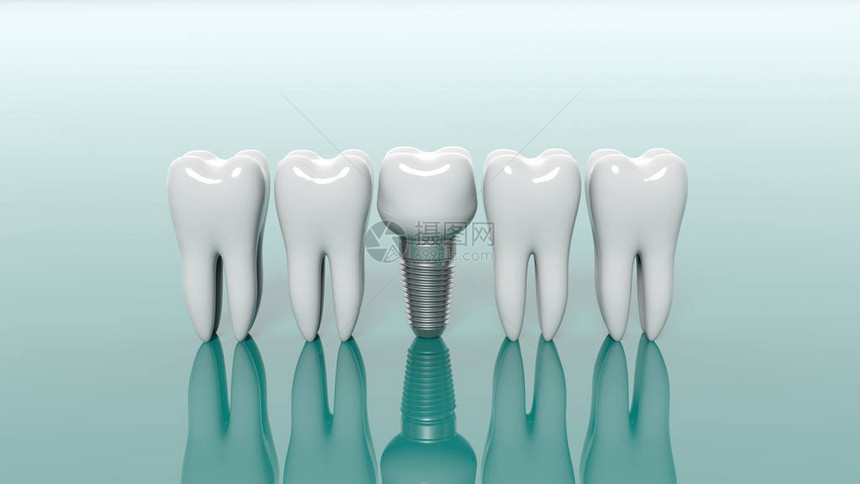 绿背景隔离的牙齿和牙科植牙图片