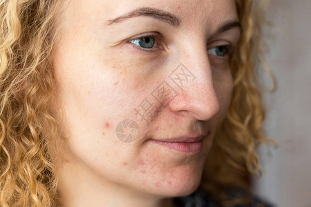 对皮肤有问题的年轻美女的肖像皮肤护理概图片