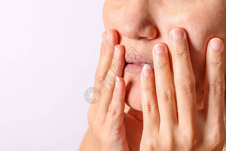 过敏女在冬季特写时有湿疹干燥的鼻子和嘴唇图片