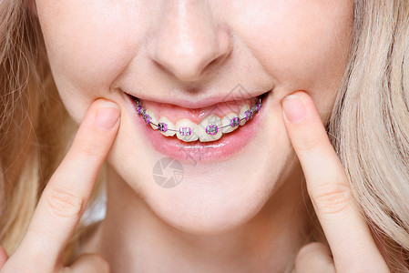 一个年轻女子用牙套指着她的牙齿的特写镜头图片